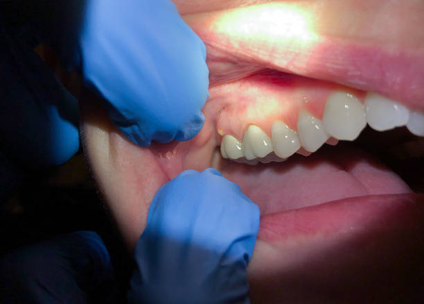 Best Knocked-Out Tooth Emergency  in Pleasanton, KS